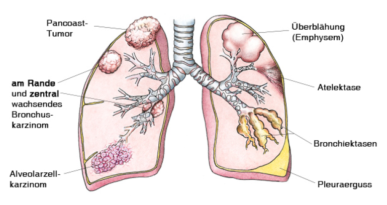 Was ist ein Bronchialkarzinom Grundlagen der Medizin für Ingenieure