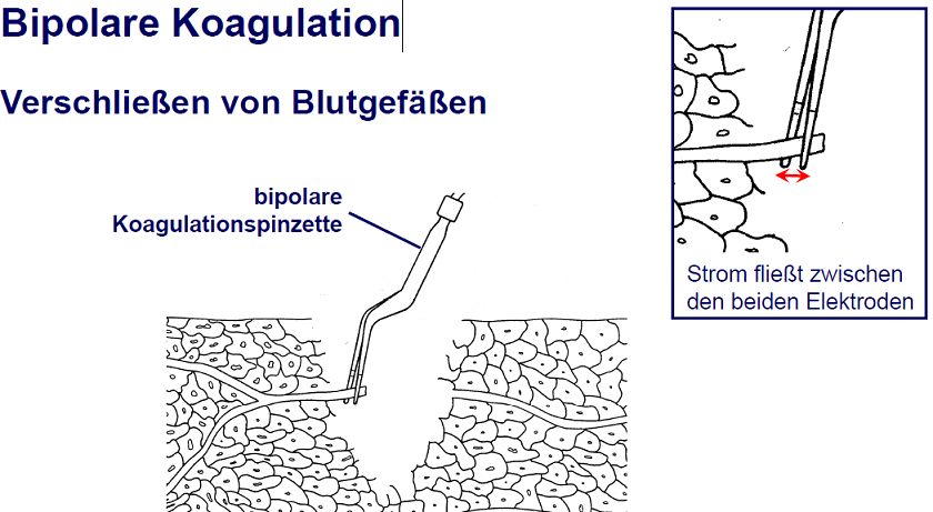 Bipolare Koagulation | MedTec Elektrochirugie | Repetico