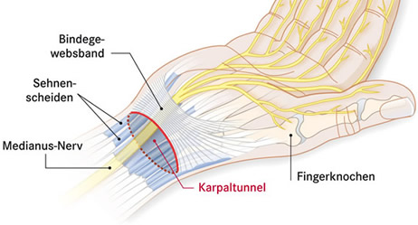 Beschreiben Sie den Unterschied zwischen Karpaltunnelsyn, alle  Prüfungen