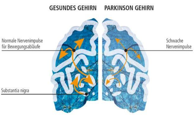 Morbus Parkinson 1. Welche Form Der Erkrankung Ist Park ...