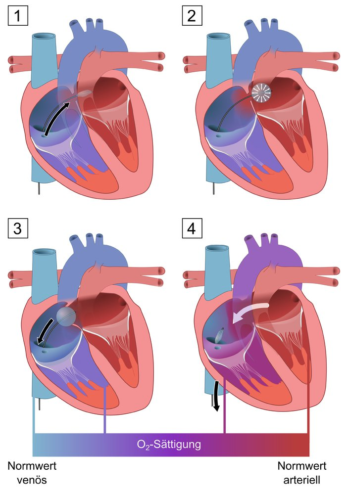Rashkind Mannöver bei Transposition großer Arterien (angebo…