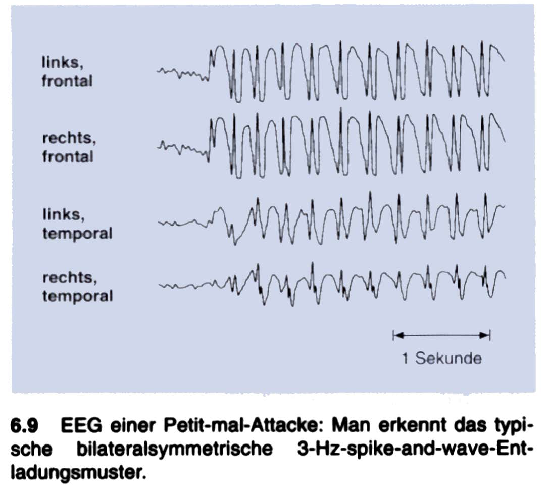 Beschreiben Sie das EEG-Muster während eines Petit-mal-... | BiologischePsychology | Repetico