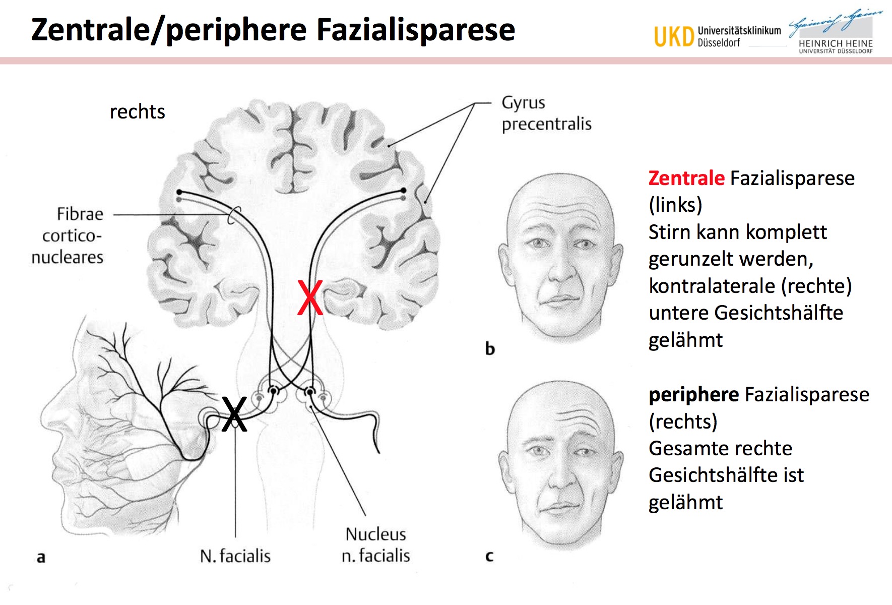 Zentrale Periphere FazialispareseUnterschied Ziwschen De Neuroanatomie N Facialis VII