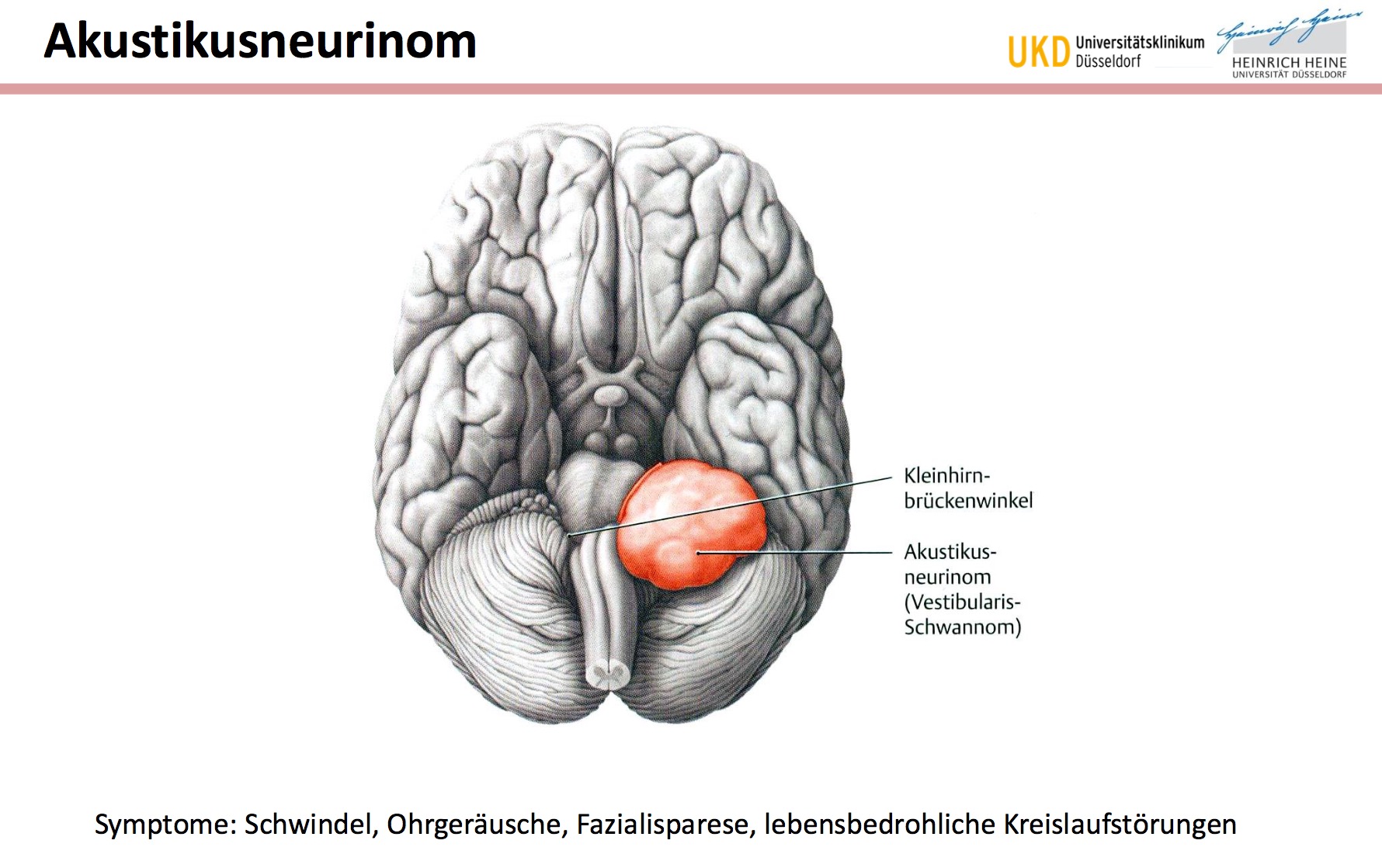 AkustikusneurinomWo tritt es auf?Symptome? | Neuroanatomie: N ...