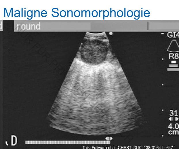 Maligne Sonomorphologie LK EBUS Repetico