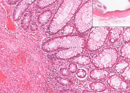 Besoderheiten bei Colitis ulcerosa | Patho-Bilder | Repetico