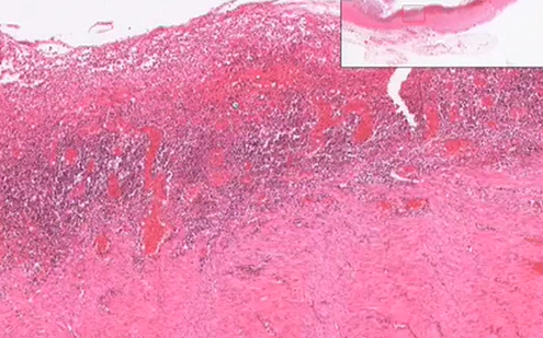 Besoderheiten bei Colitis ulcerosa | Patho-Bilder | Repetico