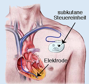 Herzschrittmacher | HKL Anatomie | Repetico