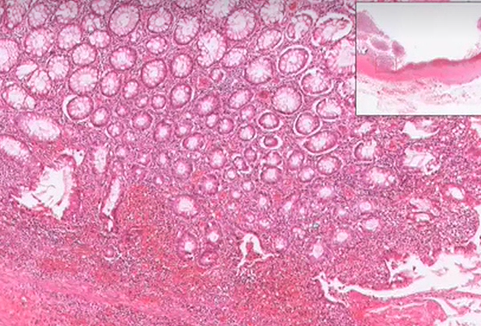 Besoderheiten bei Colitis ulcerosa | Patho-Bilder | Repetico