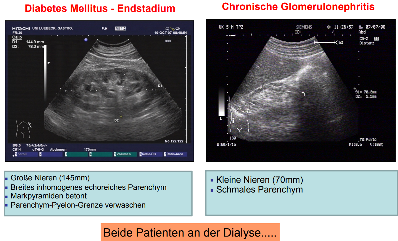 Ultraschall Niere Was Kann Man Erkennen