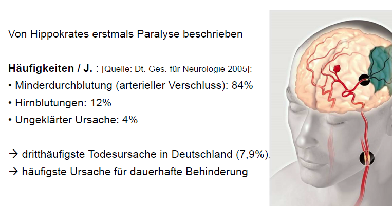 Was Ist Ein Schlaganfall Und Wie Kann Er Erkannt Werde... | Grundlagen ...