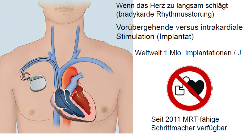 Wann Wird Ein Herzschrittmacher Eingesetzt